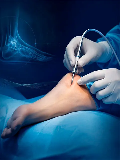 Cirurgia percutânea minimamente invasiva no pé, com instrumento cirúrgico e radiografia do tornozelo ao fundo